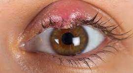 Stye & Chalazion Treatment in Dubai | Eye Specialist UAE